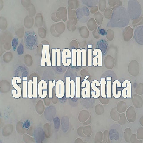 Anemia sideroblastica