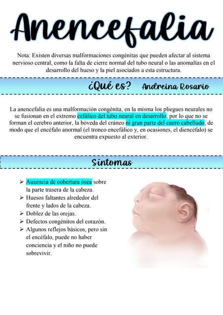 Anencefalia | PDF