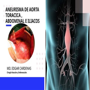 Aneurismas Aorta Abdominal infrarrenal caracteristicas | PPTX
