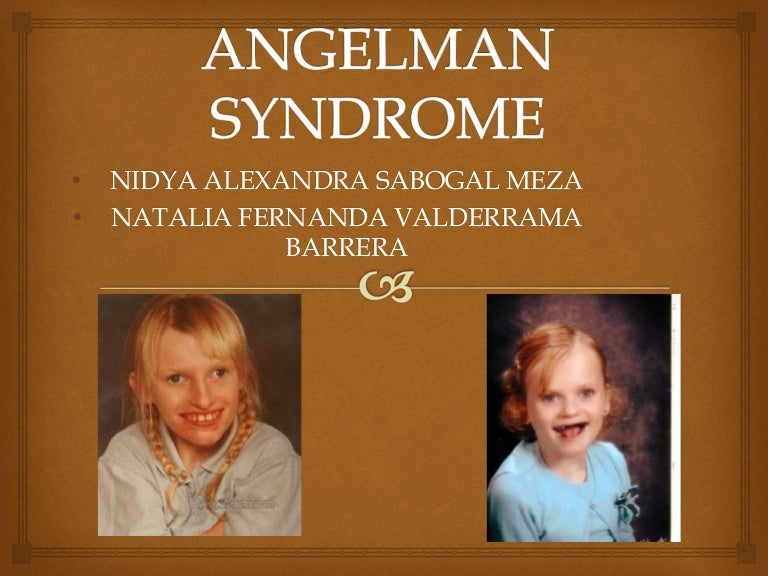 Angelman Syndrome.