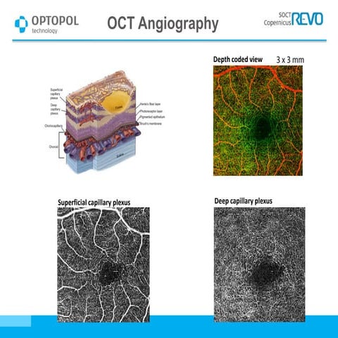 Advanced OCT Angiography Techniques for Detailed Retinal Imaging and ...