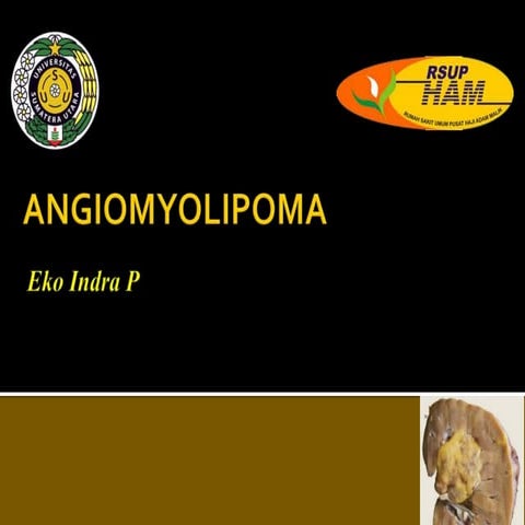 Angiomyolipoma