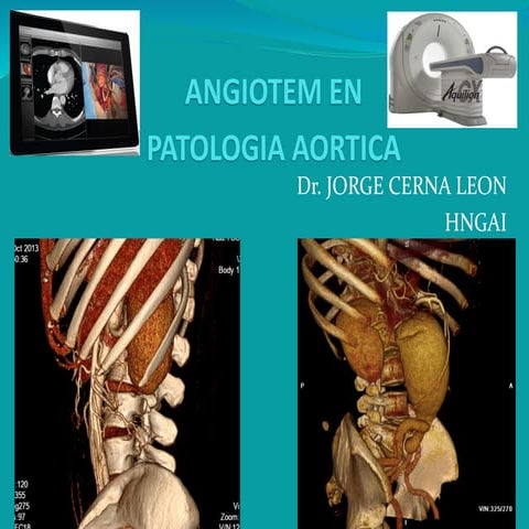 angiotc-de-miembros-inferiores-pptx