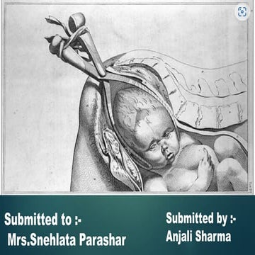 FORCEPS DELIVERY  , BSC NURSING 4 TH YEAR