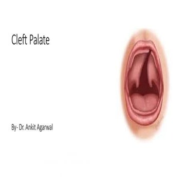 DEVELOPMENT OF PALATE AND ITS ANOMALIES | PPTX