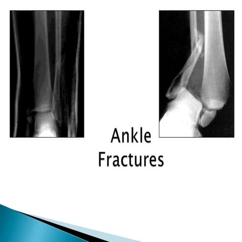 Ankle injury