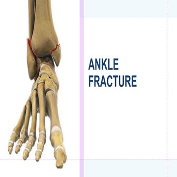 Ankle fracture