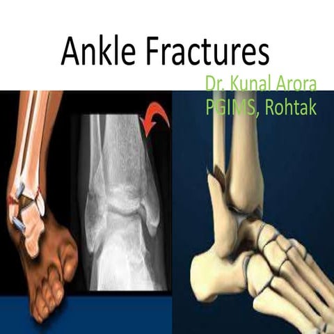 Ankle fractures | PPTX