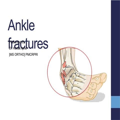 Pott’s fracture | PPTX