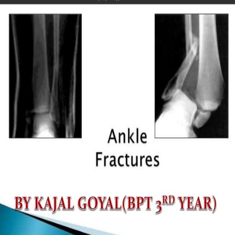 all types of Ankle fracture by kajal