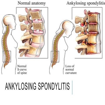 Ankylosing spondylitis