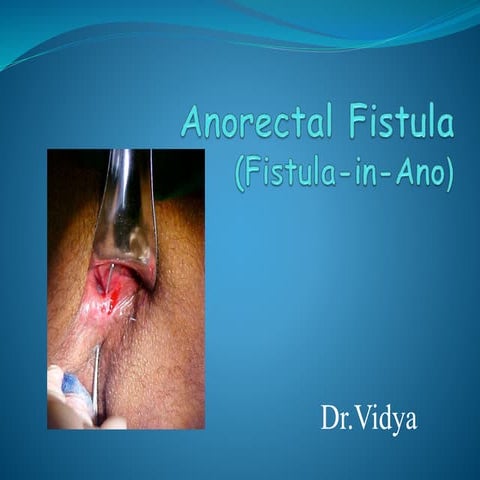 Anorectal fistula 
