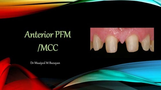 TOOTH PREPARATION: FULL VENEER ANTERIOR PFM | PPT