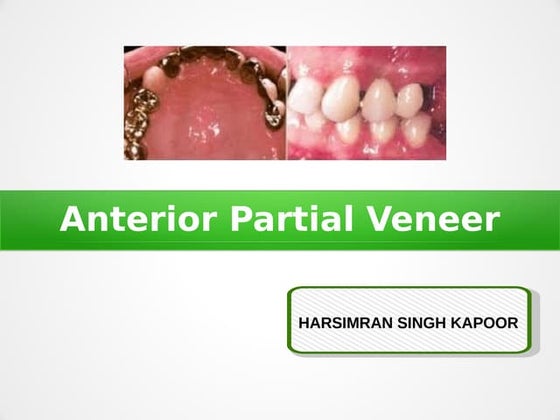 All ceramic crown preparation seminar | PPT