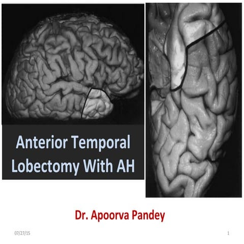 Anterior temporal lobectomy