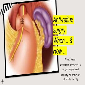 Anti reflux surgery [Autosaved].pptx