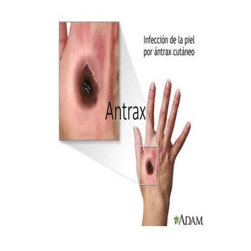 Antrax | PPTX