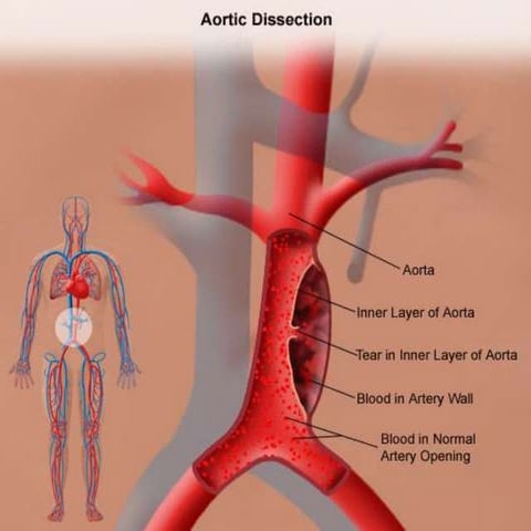 Aortic dissection nikku ppt