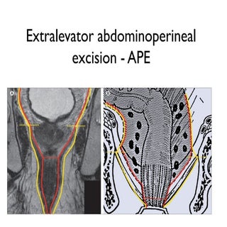 Extralevator abdominoperineal excision