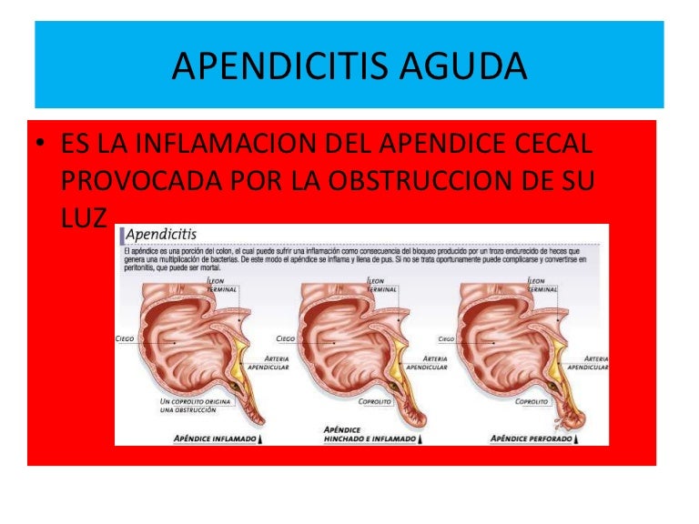Apendicitis aguda