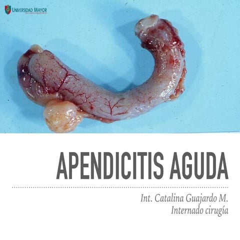 Apendicitis aguda