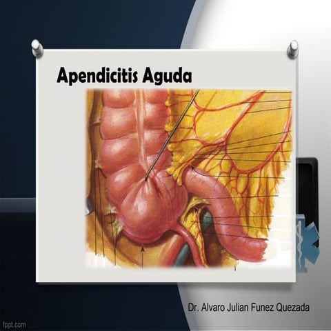 Apendicitis aguda