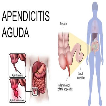 APENDICITIS AGUDA MODELO 1.pdfbdbdjjdbdn