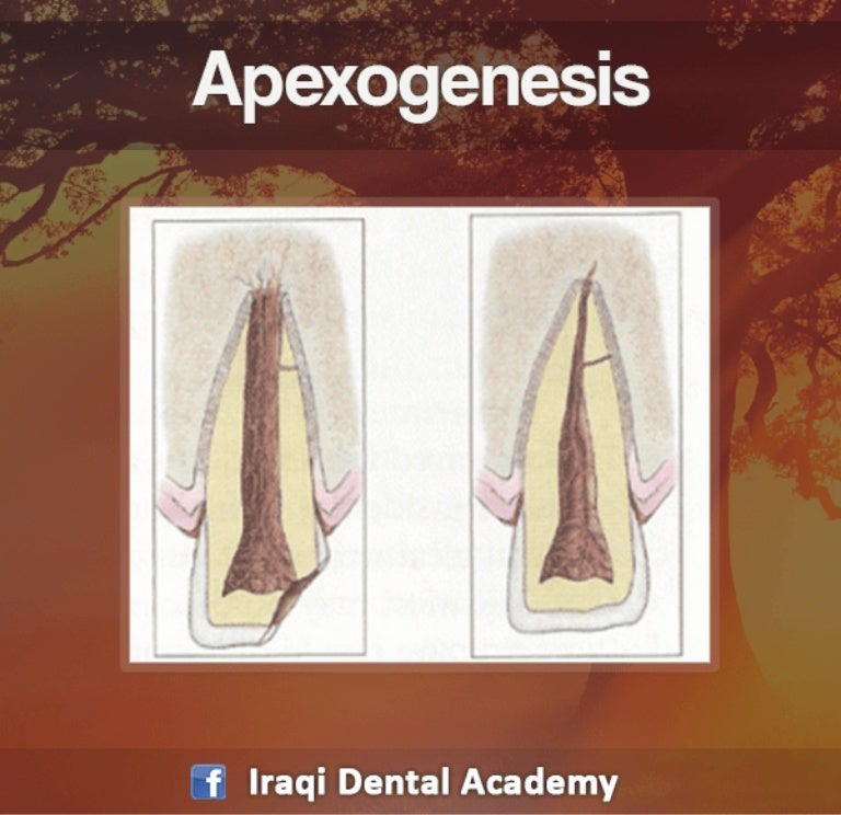 Apexogenesis Procedure A Pediatric Lecture