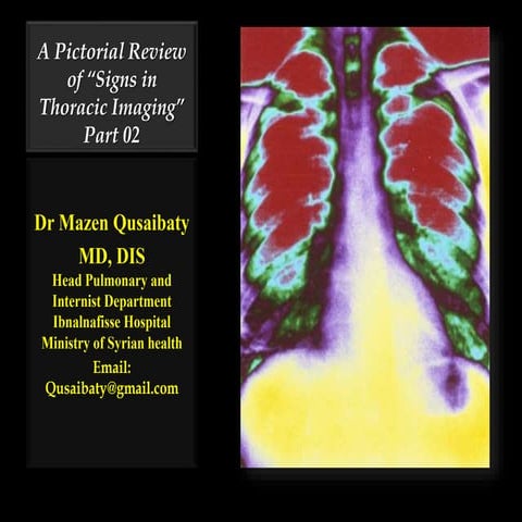 A pictorial review of “signs in thoracic imaging 02” | PPTX