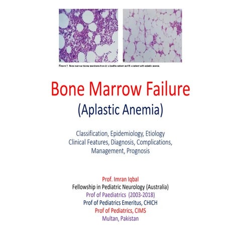 Aplastic anemia in children 2021