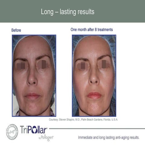 Before and After- Apollo | PPTX