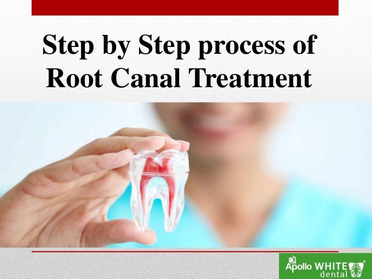 step by step process of Root canal treatment