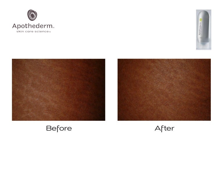 apothederm stretch mark cream