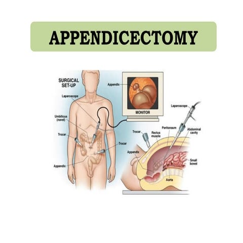 appendicectomy ppt for knowledge for medical graduate