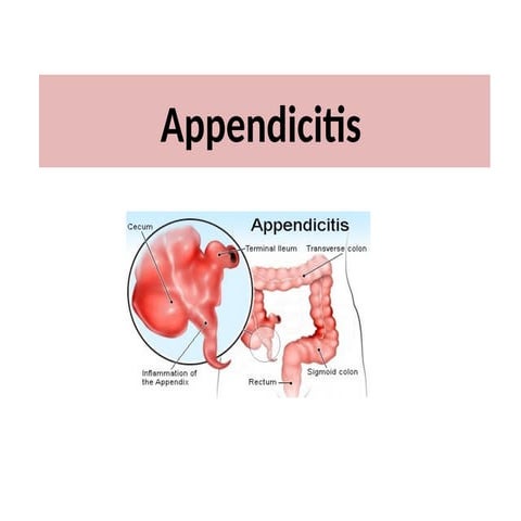 An Introduction to Appendicitis and its Management