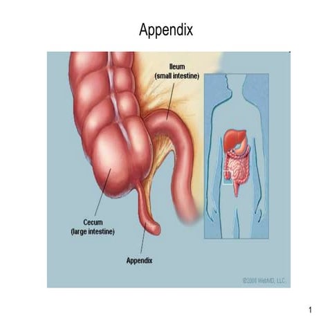 Appendicitis ,pathophysiology and its management | PPT