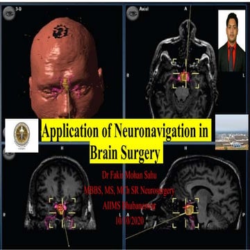 Application of Neuronavigation in Brain Surgery