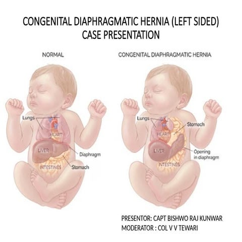Cong Diaphragmatic Hernia _ Case _ Presentation.pptx