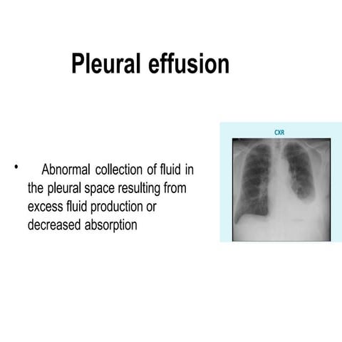 approach to pleural effusions 1 - Copy.pptx