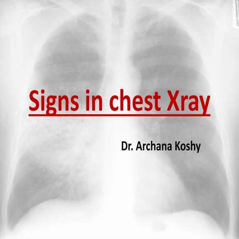 Radiological signs in chest medicine part 2 | PDF