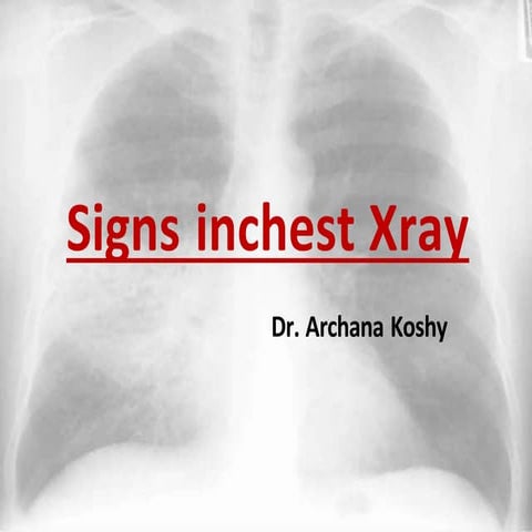 arch-k-signs-in-chest-xray-160210003601.pptx