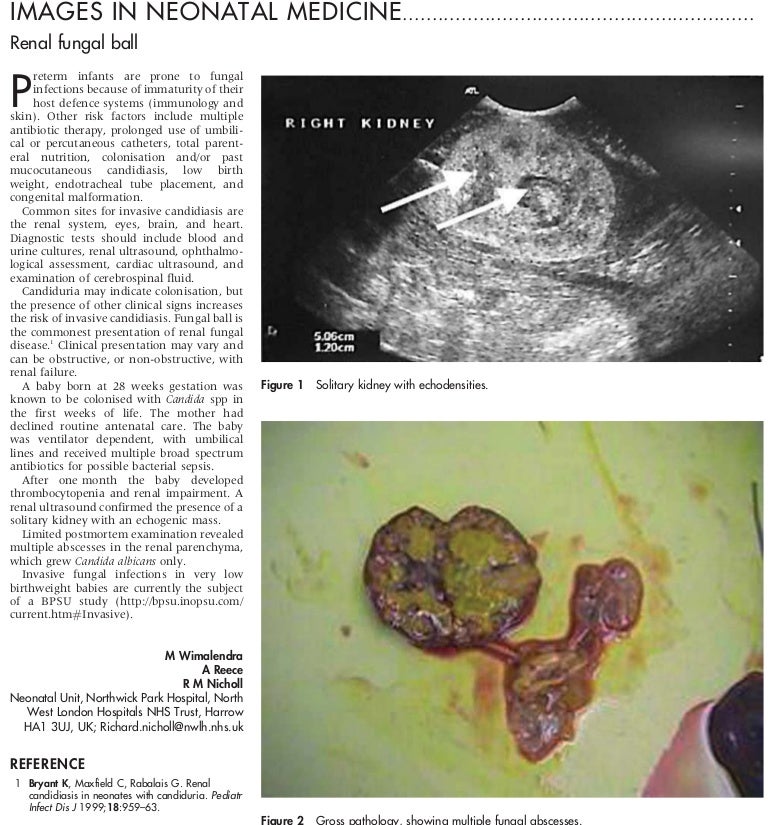 Renal Fungal Ball