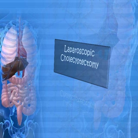 Laparoscopic Cholecystectomy