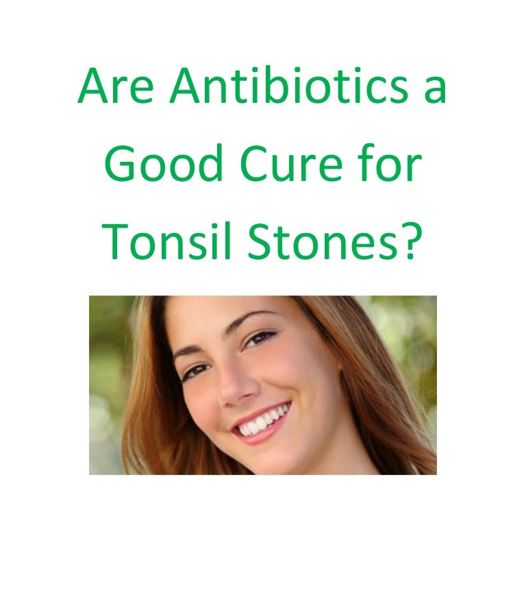 Are antibiotics a good cure for tonsil stones