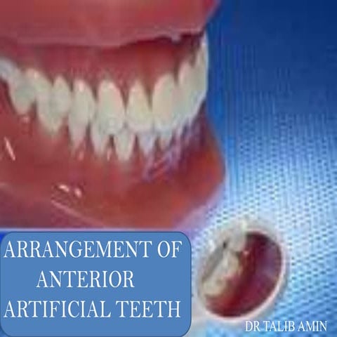 Arrangement of anterior artificial teeth