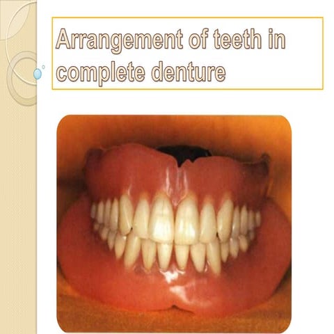 Arrangement of teeth in complete denture