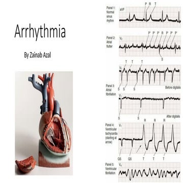 arrhythemia lecture for students of pharmacy college