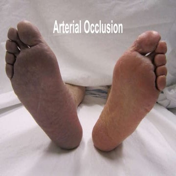 Arterial occlusion