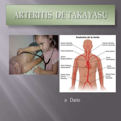 Arteritis  de takayasu