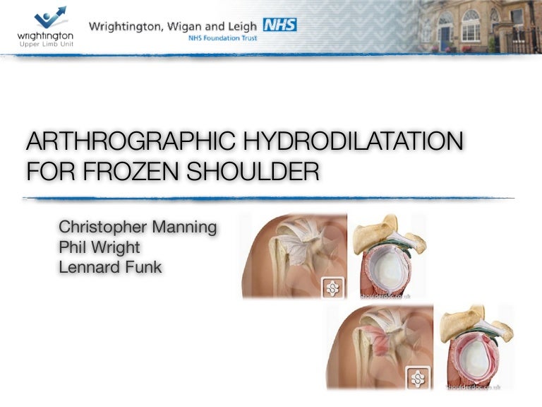 Arthrographic hydrodilatation for frozen shoulder
